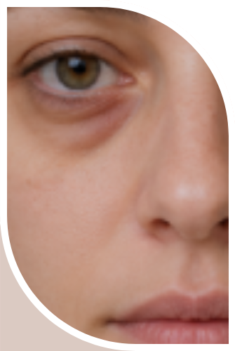 ojeras